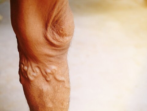 The severity of the varicose veins ranges from the tiny capillaries, pain in the legs, swollen feet and legs, and the crooked aneurysm resembles a worm.