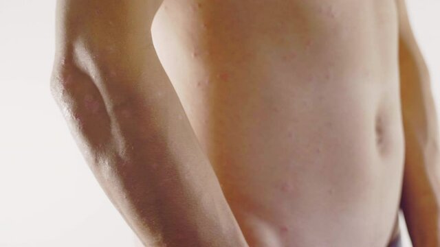 homme, psoriasis, ecz&eacute;ma, probl&egrave;me de peau, m&eacute;dicale, corps, femme, nu, sein, beaut&eacute;, jeune, beau, peau, torse, poitrine, sant&eacute;, blanc, mod&egrave;le, fitness, musculaire, mince, isol&eacute;, sain, arri&egrave;re, main, 