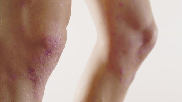 homme, psoriasis, ecz&eacute;ma, probl&egrave;me de peau, m&eacute;dicale, corps, femme, nu, sein, beaut&eacute;, jeune, beau, peau, torse, poitrine, sant&eacute;, blanc, mod&egrave;le, fitness, musculaire, mince, isol&eacute;, sain, arri&egrave;re, main, 