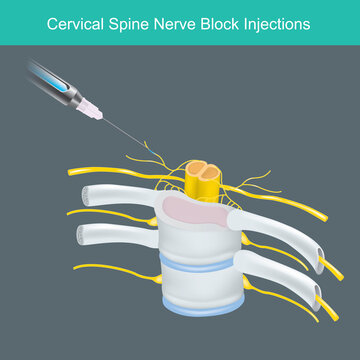 Cervical Spine Nerve Block Injections. Illustration for learning Anesthetic solution injected the human neck cervical spine nerve..