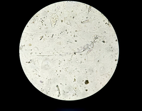 Yeast Infection; Budding yeast and pseudohyphae of Candida albicans. This fungus commonly affects vagina and vulva, oral (thrush) and diaper rash.