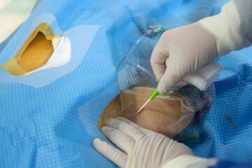 Scrub nurse press at puncture site of patient’s groin. Focus at introducer sheath. - obrazy, fototapety, plakaty
