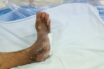 infected wound of diabetic foot.  signs of the disease diabetes