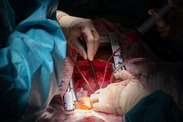 coronary artery bypass graft operation (CABG). Surgery for Coronary Artery Bypass Grafting: CABG....