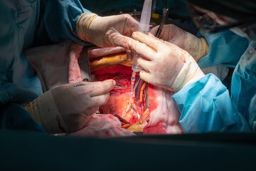 coronary artery bypass graft operation (CABG). Surgery for Coronary Artery Bypass Grafting: CABG. The doctor and staff are treating with open heart cardiac bypass surgery in full operation 