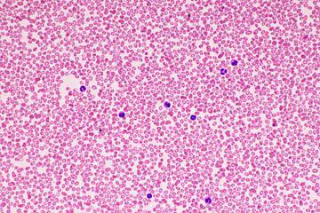 Red blood cells in blood smear, Wright-Giemsa stain, analyze by microscope, 400x