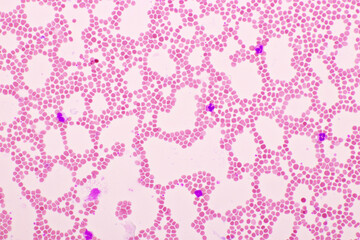 Red blood cells in blood smear, Wright-Giemsa stain, analyze by microscope, 400x