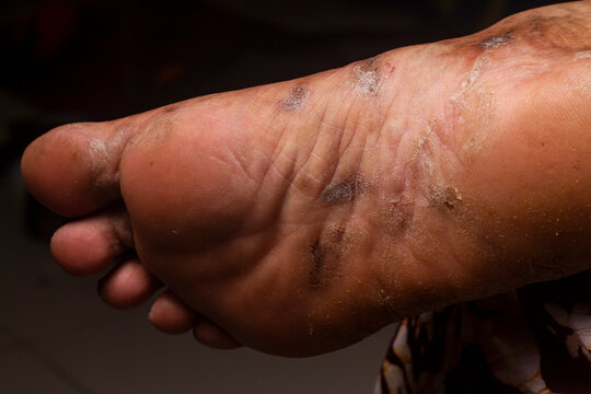 Closeup Of The Foots Sole Of A Woman Suffering From Chronic Psoriasis On A Black Background. Closeup Of Rash And Scaling On The Patient's Skin. Dermatological Problems. Dry Skin Isolated