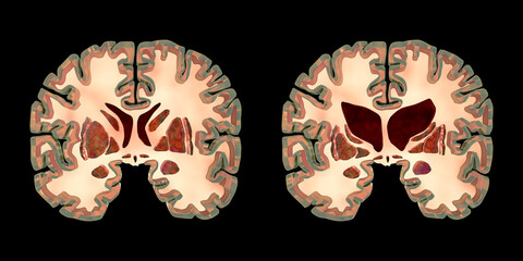 Coronal sections of a healthy brain and a brain in Huntington's disease