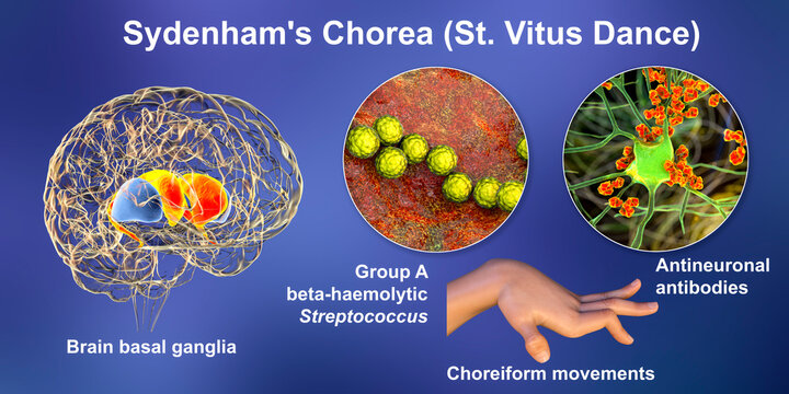 Sydenham's chorea, an autoimmune disease that results from childhood infection with Streptococcus bacteria
