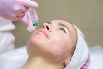 The doctor gives injections of blood plasma into the face of a young girl. Therapeutic procedure, plasmolifting