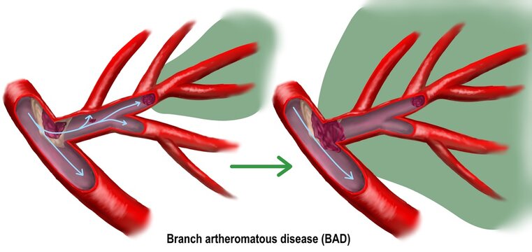 Branch atheromatous disease is one cause of progressive ischemic stroke.