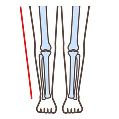 変形性膝関節症　図解