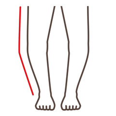 変形性膝関節症　図解