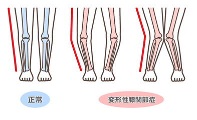 変形性膝関節症　図解