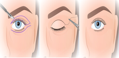 blepharoplasty procedure, plastic surgery of the upper eyelid