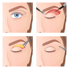 upper eyelid plastic surgery procedure, step by step process