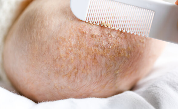 removing or loosen cradle cap of seborrheic dermatitis of baby's head with comb