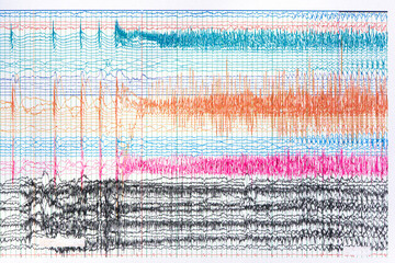 Photograph of ictal EEG during seizure - obrazy, fototapety, plakaty
