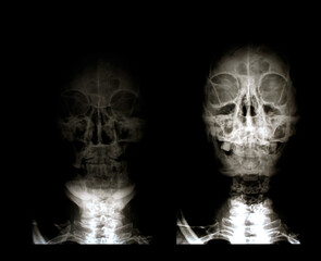 Head x-ray film images used to diagnose neurological and tumor diseases for diagnosis.