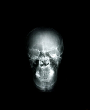 Head x-ray film images used to diagnose neurological and tumor diseases for diagnosis.