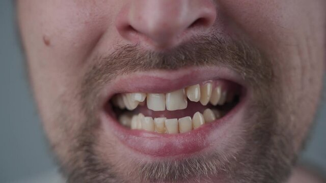 Dental displacement. Male mouth with crooked teeth and malocclusion. Crowding of teeth of the upper jaw. Orthodontics. Overcrowded teeth, abnormal dental occlusion. Teeth before install braces