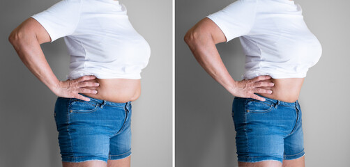 Before And After Weight Loss Liposuction