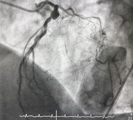 Coronary angiogram shown left anterior descending artery (LAD) stenosis with coronary aneurysm.