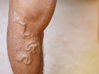 The severity of the varicose veins ranges from the tiny capillaries, pain in the legs, swollen feet...