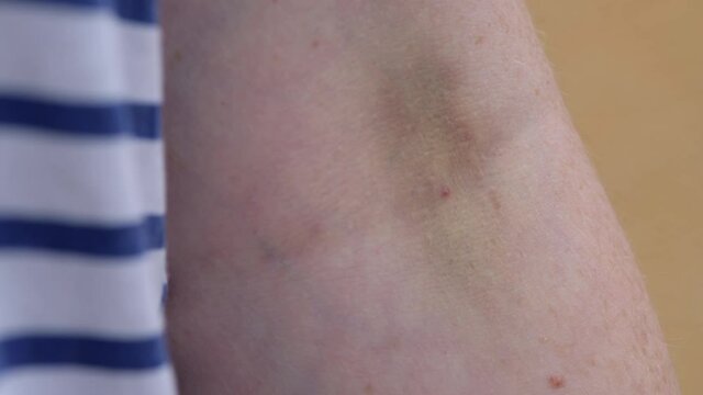 Vein hematoma on female hand after phlebotomy