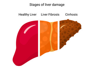 Stage of liver damage. Design for poster, infographic, presentation. Liver disease.