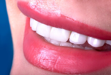 Perfect Close Up White beautiful Veneers Teeth bleaching crowns whitening young lady smiling, Sensual female plump Lips woman smile. Dental zircon implants restoration surgery. Fashion concept