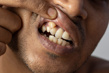 irregular teeth