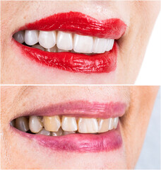 teeth treatments with crowns and venners