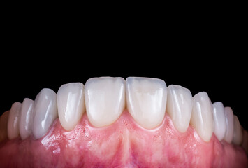 teeth treatments with crowns and venners