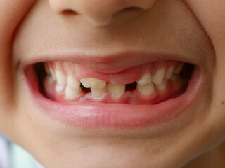Kid with broken teeth, Gap in teeth