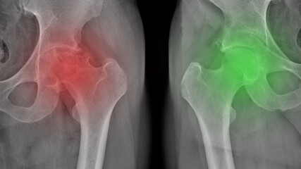 X-ray of a painful hip in a man with osteoarthritis of the left hip joint in the red area, very...