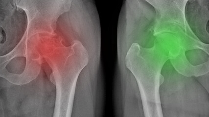 X-ray of a painful hip in a man with osteoarthritis of the left hip joint in the red area, very painful, difficult to walk, worn out joint, endoprosthetics. Surgical work required