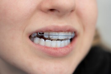 Nahaufname Zahnspange bei einem jungen M&auml;dchen