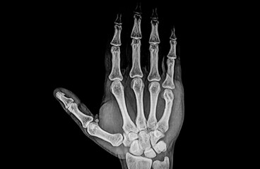 X-ray image of left hand show fracture at little finger (phalanxes)