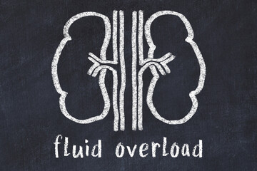 Chalk drawing of human kidneys and medical term fluid overload. Concept of learning medicine