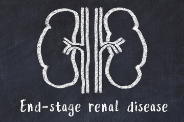 Chalk drawing of human kidneys and medical term End-stage renal disease. Concept of learning medicine
