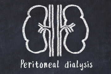 Chalk drawing of human kidneys and medical term Peritoneal dialysis. Concept of learning medicine