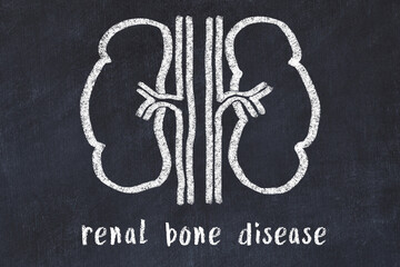 Chalk drawing of human kidneys and medical term renal bone disease. Concept of learning medicine