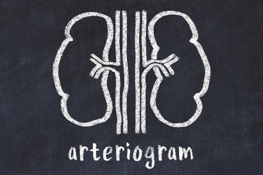 Chalk Drawing Of Human Kidneys And Medical Term Arteriogram. Concept Of Learning Medicine