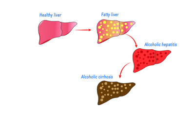 Alcoholic liver disease [Fatty liver, hepatitis, cirrhosis]