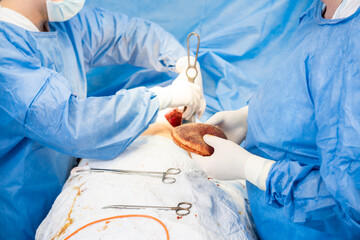Breast augmentation under the guidance surgeons team in surgical operating room.