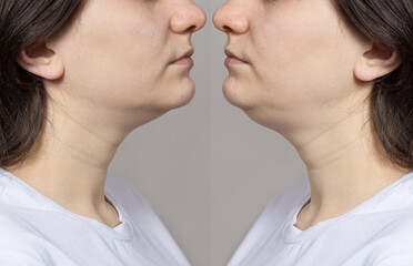 The woman has a double chin. Chin reshaping, fat removal, lifting. Collage comparison before and...