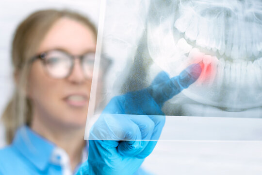Close-up woman dentist looks at a panoramic x-ray image of a patients jaw in the dental office and points a finger at a sore tooth with red markings. Dentistry, medicine technology concept