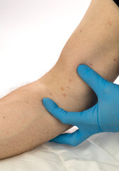 Tinea in a mans armpit beeing inspected